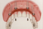 All on Four Dental Implant Placement Process