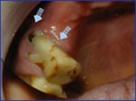 Splaying due to Tooth Loss
