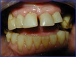 Overeruption of the Teeth