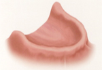 Removable Mini-Implant Supported Denture