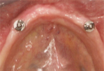 Placement of Mini-Implants for Overdentures