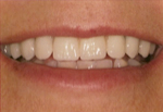 Results from Mini-Implant Supported Overdentures