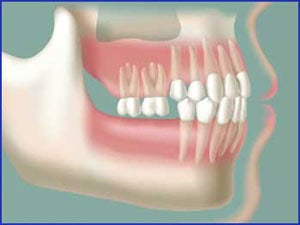 over eruption of teeth in new york new jersey implant erupted tooth