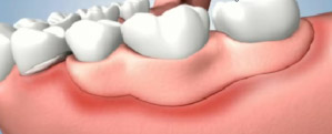 Shifting Removable Partial Dentures
