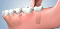Replacing Several Teeth with a Implant Supported Bridge