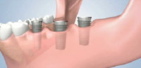 Dental Implant Placement Manhattan