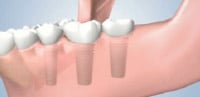Individual Dental Crown Placement