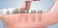 Dental Implants Placed for Each Missing Tooth