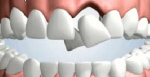 Partial Bridges for Single Tooth Replacement