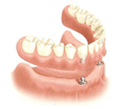 Overdenture Seated on Ball Attachment
