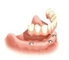 Fixed Bridge on Dental Implants