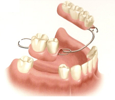 Treatments for Multiple Missing Teeth