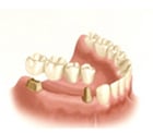 Tooth-Supported Fixed Bridge