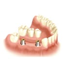 Implant Supported Fixed Bridge