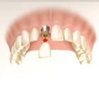 Single Tooth Dental Implant