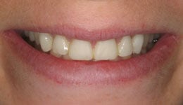 Laser Crown Lengthening with Veneers