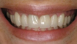 Laser Lengthening for New Crowns and Veneers
