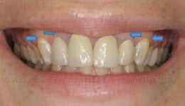 Laser Esthetic Crown Lengthening