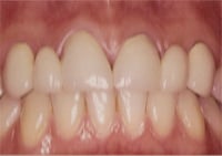 Before Worn & Discoloured Bridges