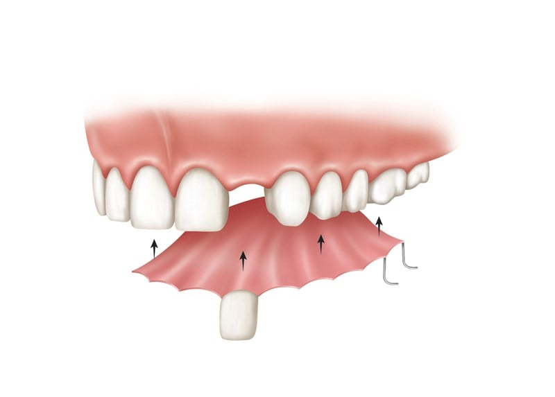 Dental Bridge Vs. Dentures - Dental Implants Specialists ...