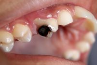 How Black Mold Can Cause Tooth Decay Image
