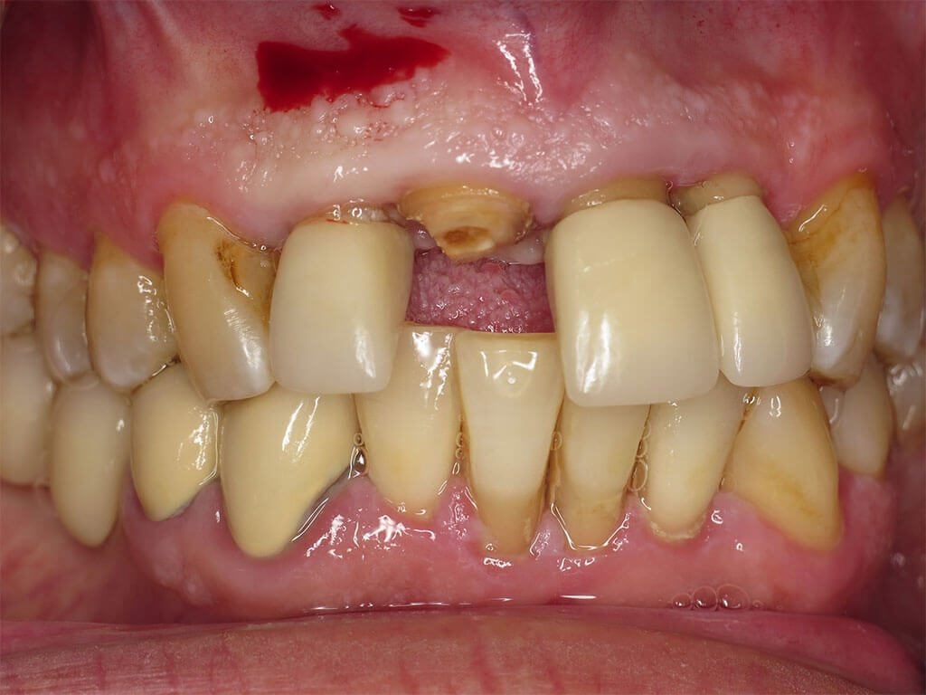 Clinical view of broken tooth #8.