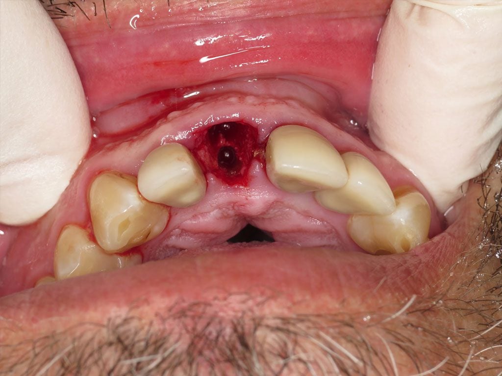 View of extracted tooth #8.