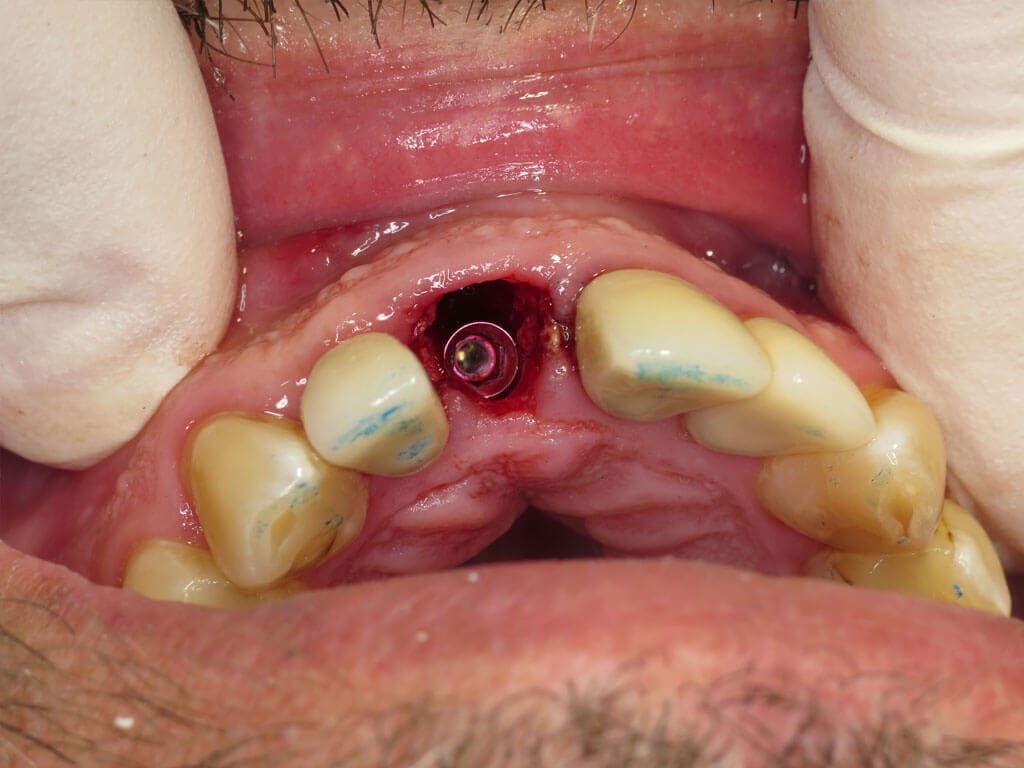 Clinical view of implant and abutment inserted.