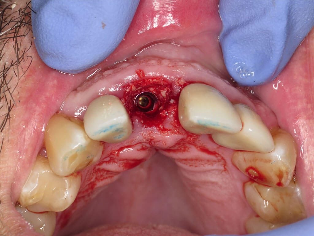 Bone graft material and membrane placed surrounding the implant and abutment.