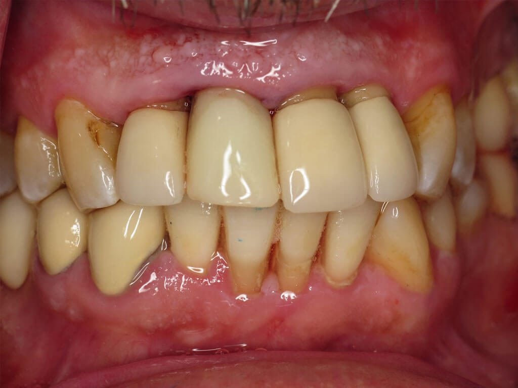 Clinical view of final restoration.