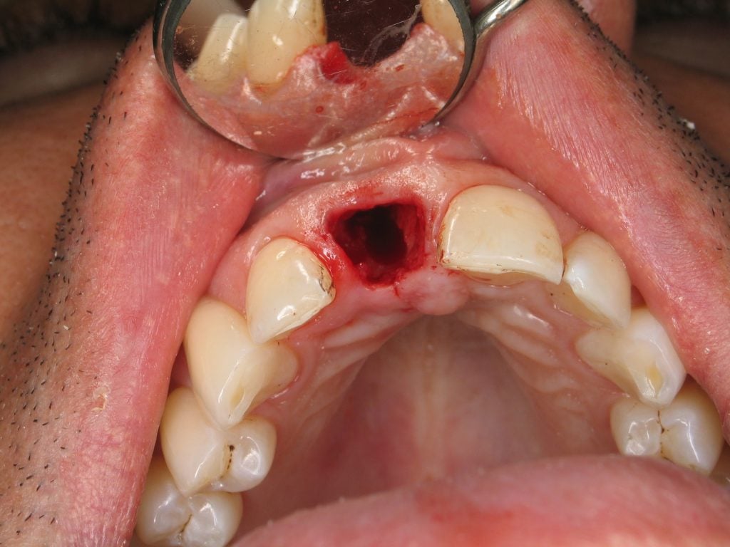 Clinical view of extracted tooth #8: