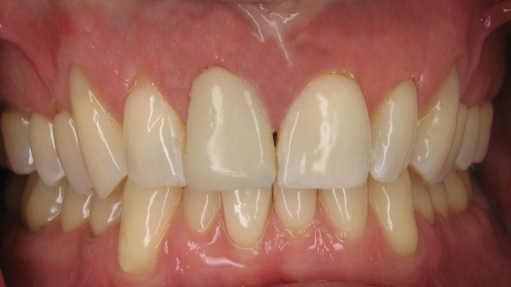 Clinical view of final restoration: 
