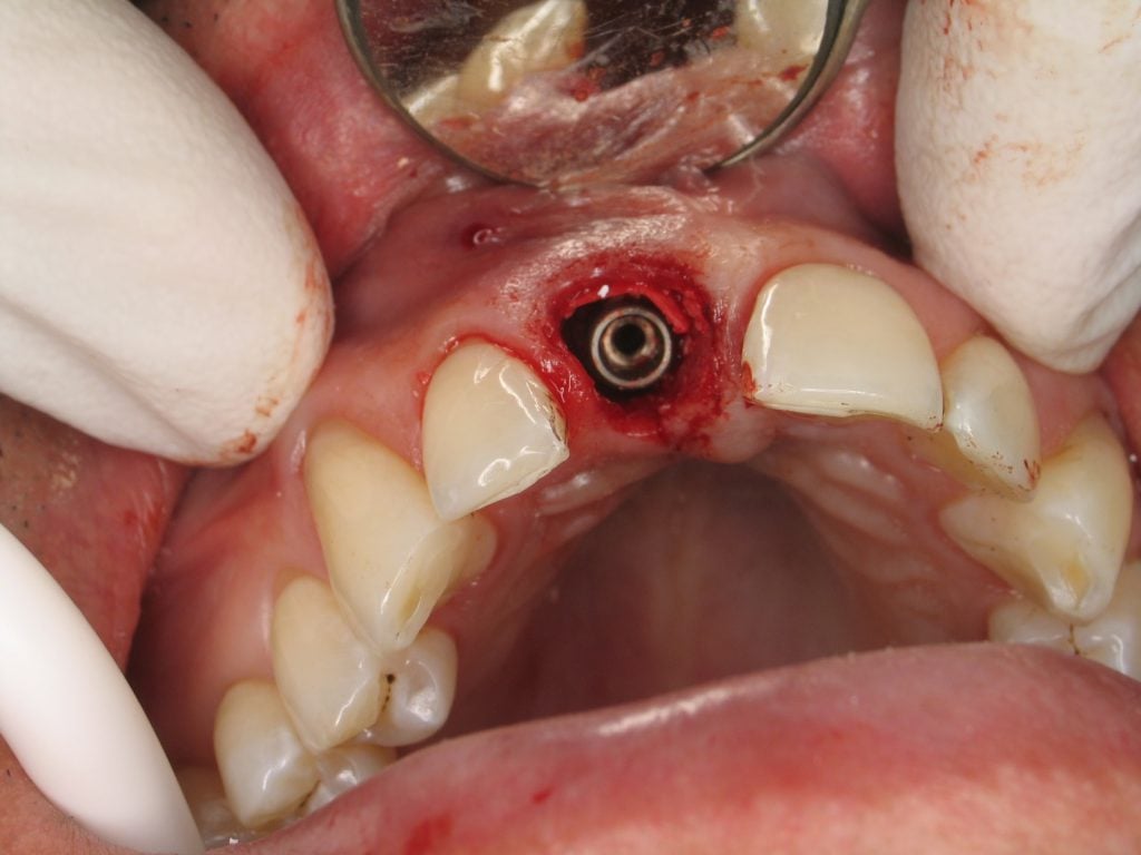 View of titanium implant inserted.