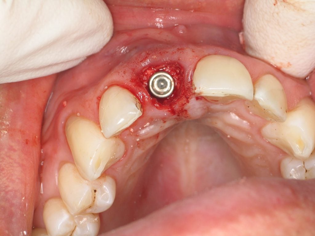Bone graft material utilized to fill the gap between the implant and the empty tooth socket.