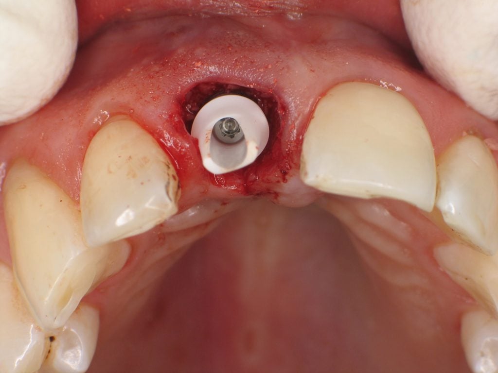 Zirconia Abutment inserted to the dental implant. 