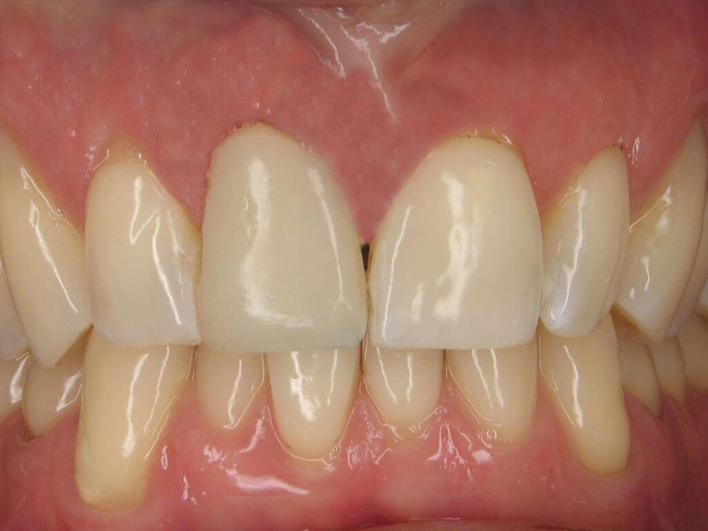 Extraction, Bone Graft, and Implant for Missing Tooth