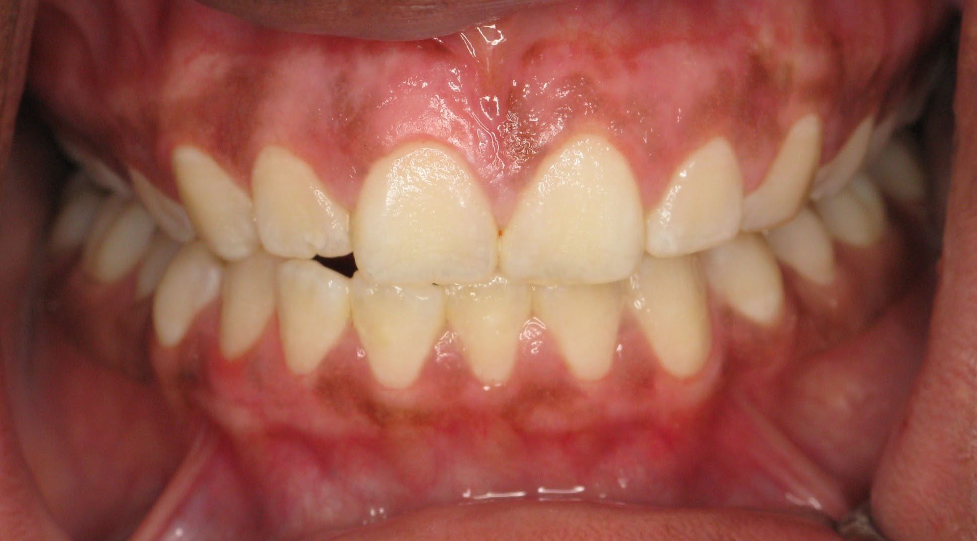 Gums Lightened to Match Rest of Mouth
