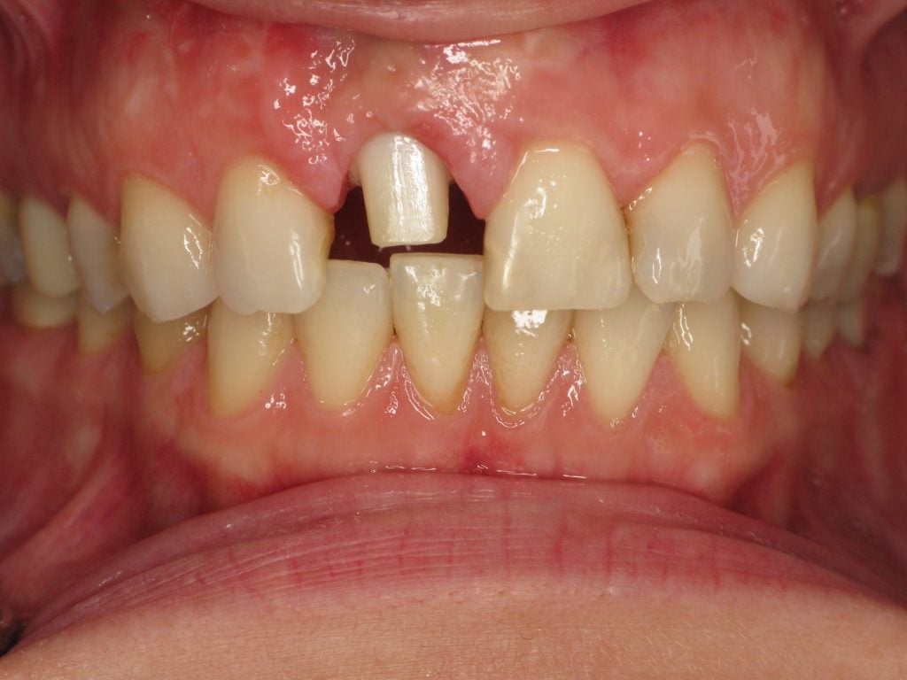 Zirconia abutment attached to the implant. 