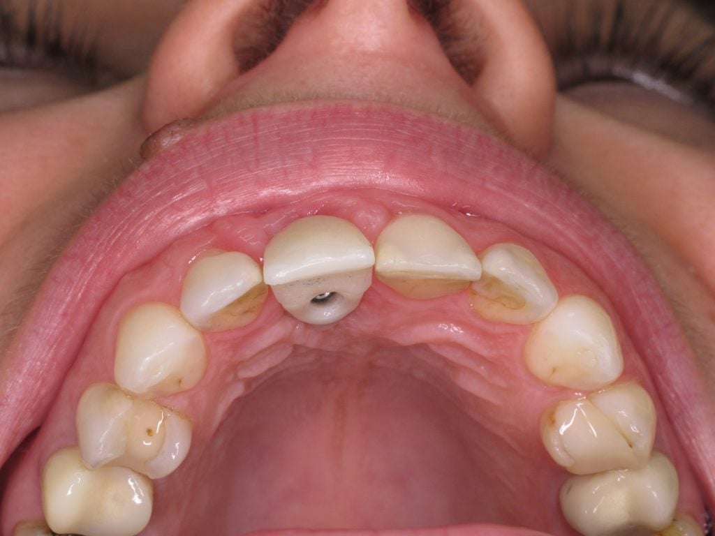 Artificial tooth screwed into place. 