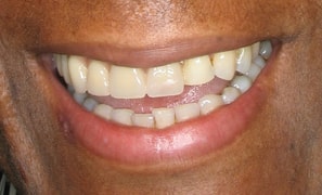 Dentures Replaced with Permanent Teeth