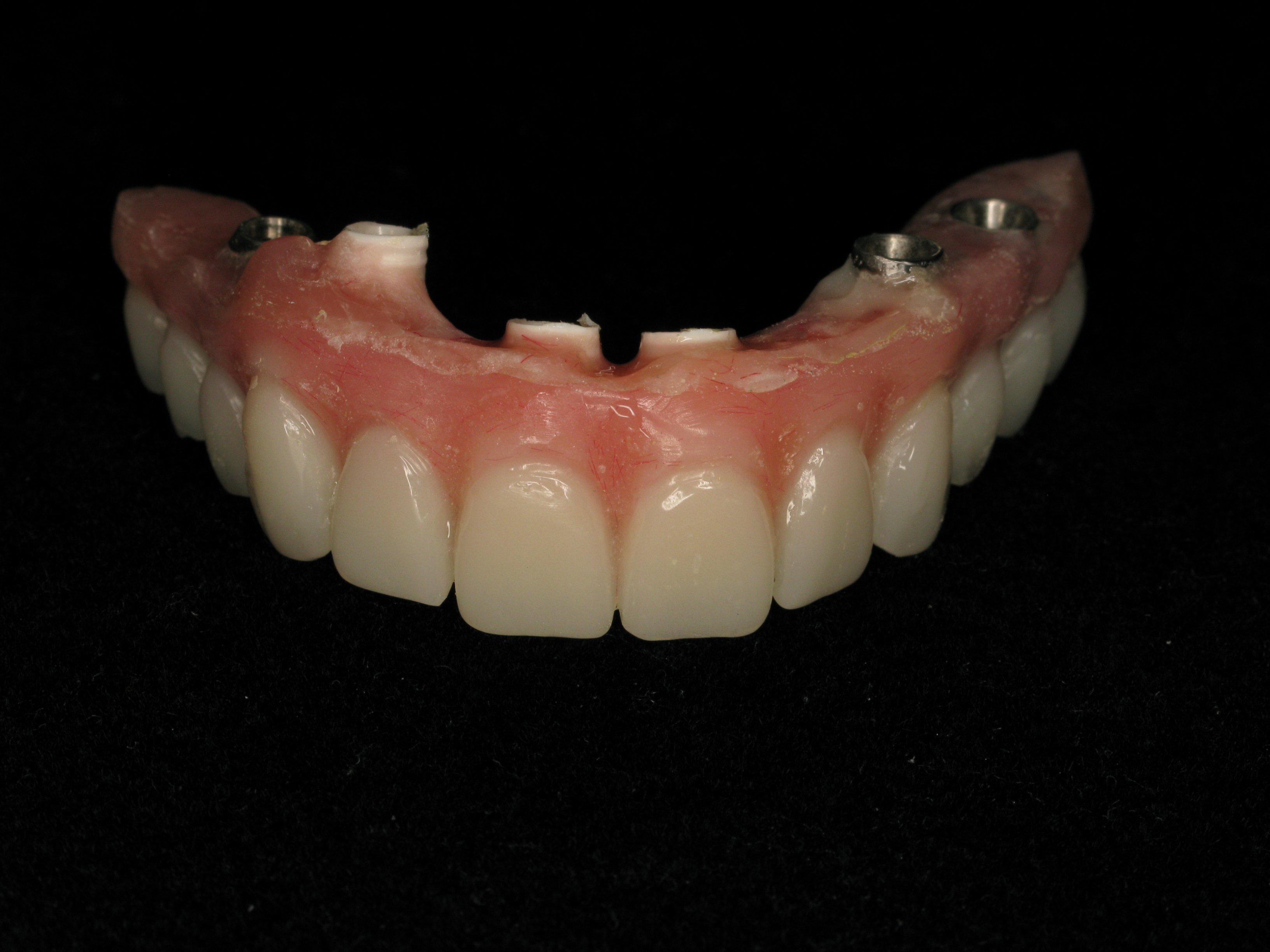 Replaced Upper and Lower Dentures with All On 4 Advanced Periodontics