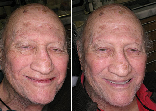 Replaced Lower Denture with All On 4