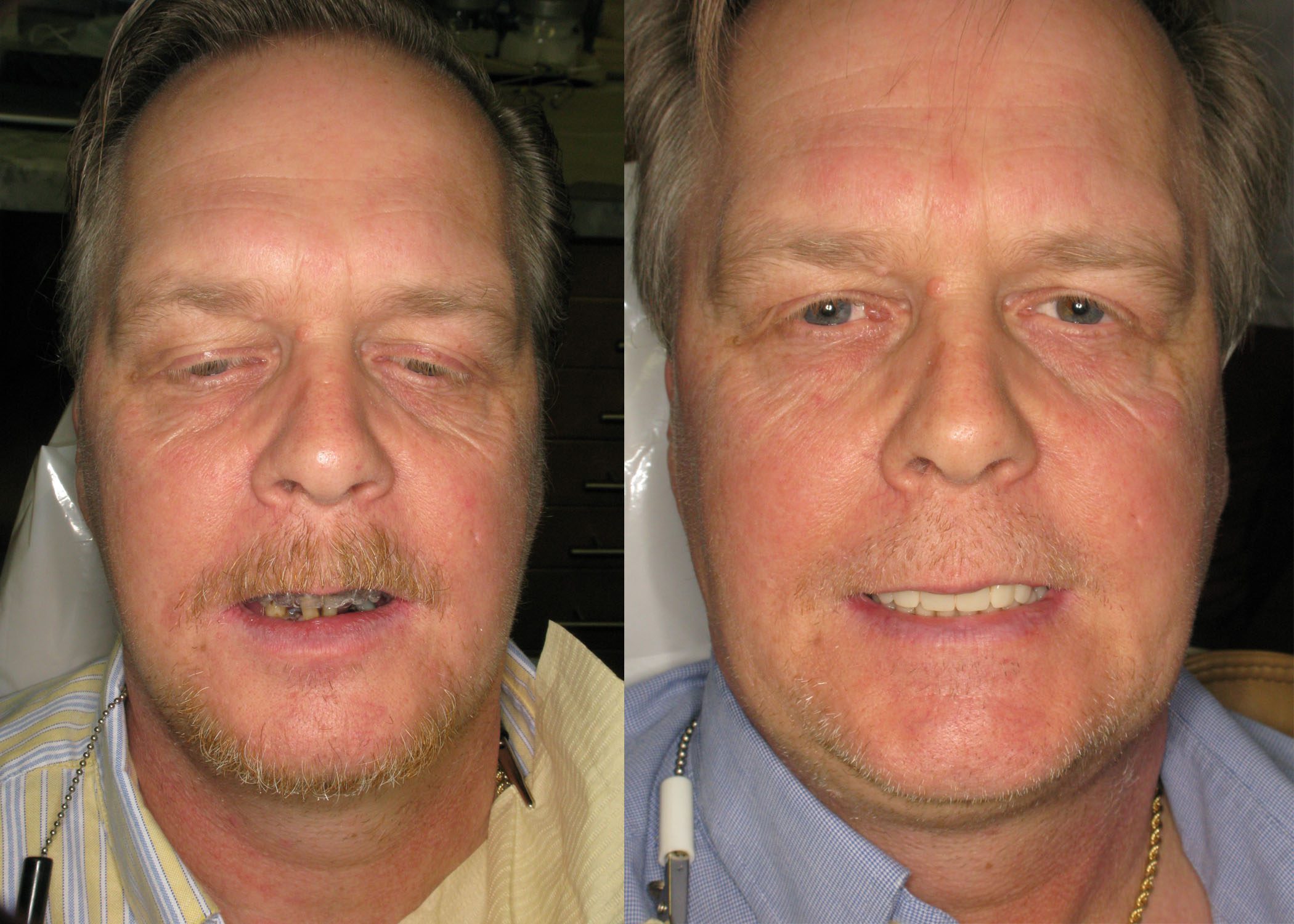 Upper Denture and Lower Partial to All On 4
