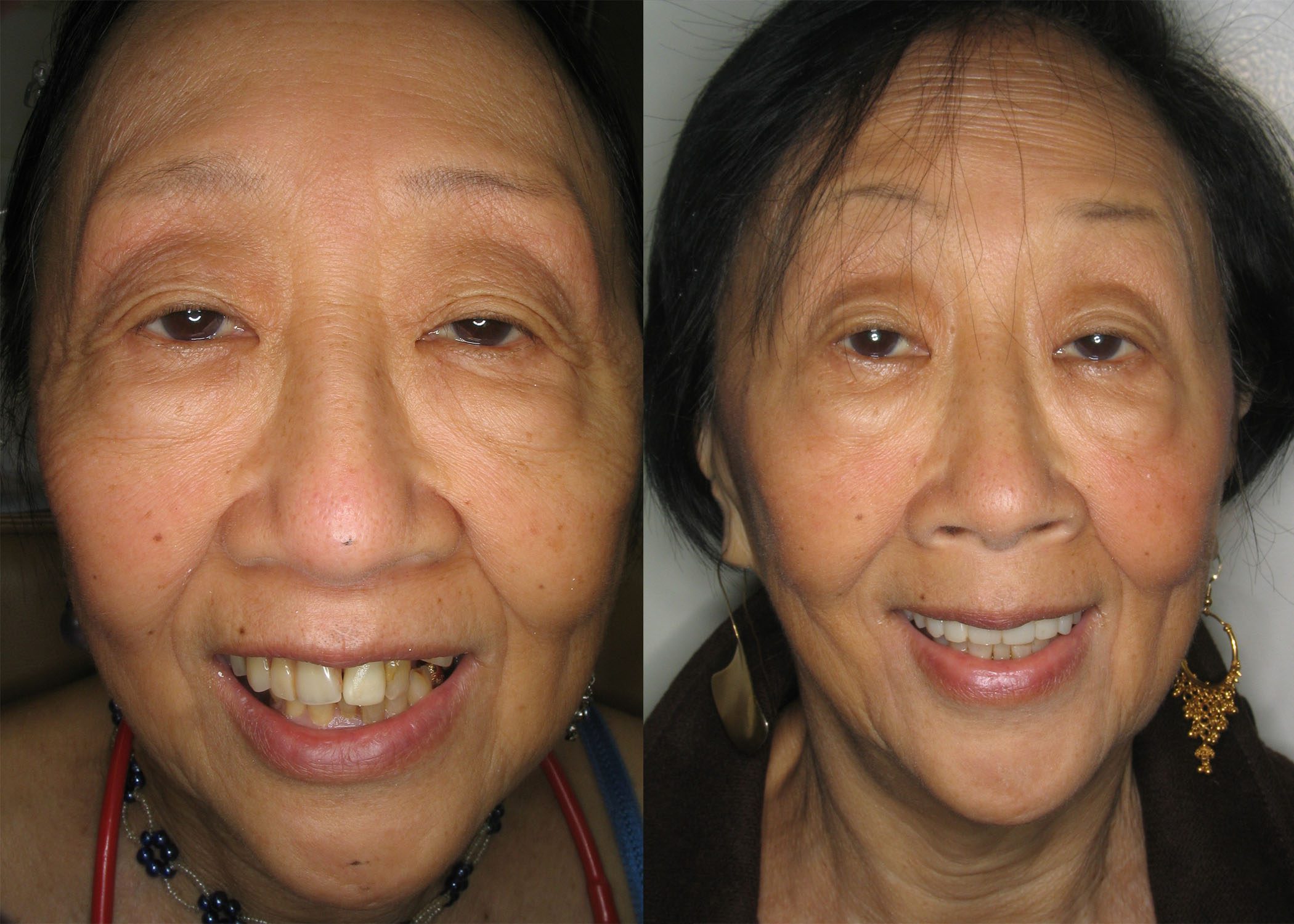 Replaced Partial Dentures for All On 4