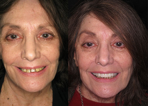 Smile-In-A-Day Patient with Severe Periodontal Disease