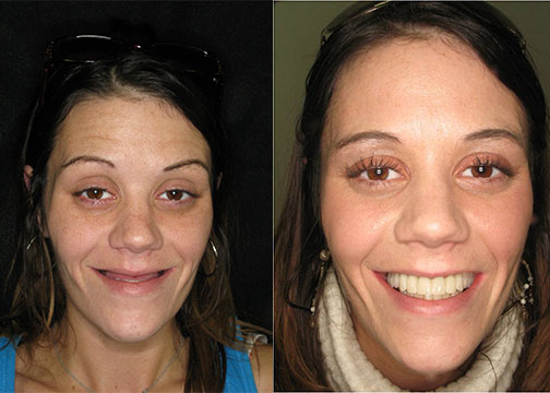 From Losing All Her Teeth, to a Full Smile Restoration