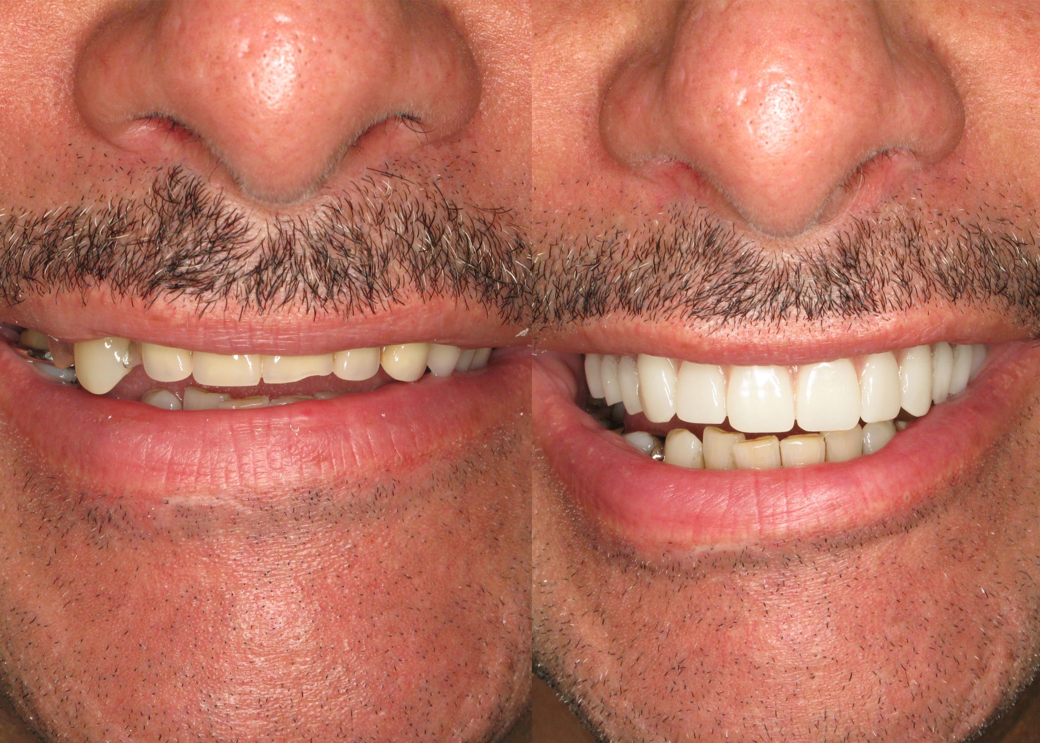 Replaced Upper and Lower Dentures with All On 4