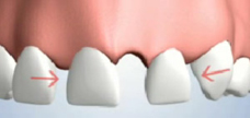 Teeth Shifting Due to Single Tooth Loss
