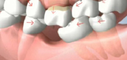 Teeth Drifting from Single Tooth Loss