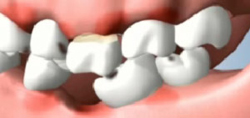 Periodontal Disease Developing after Tooth Loss